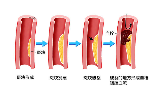 不想斑块破裂，形成血栓，这3件事一定要做到位
